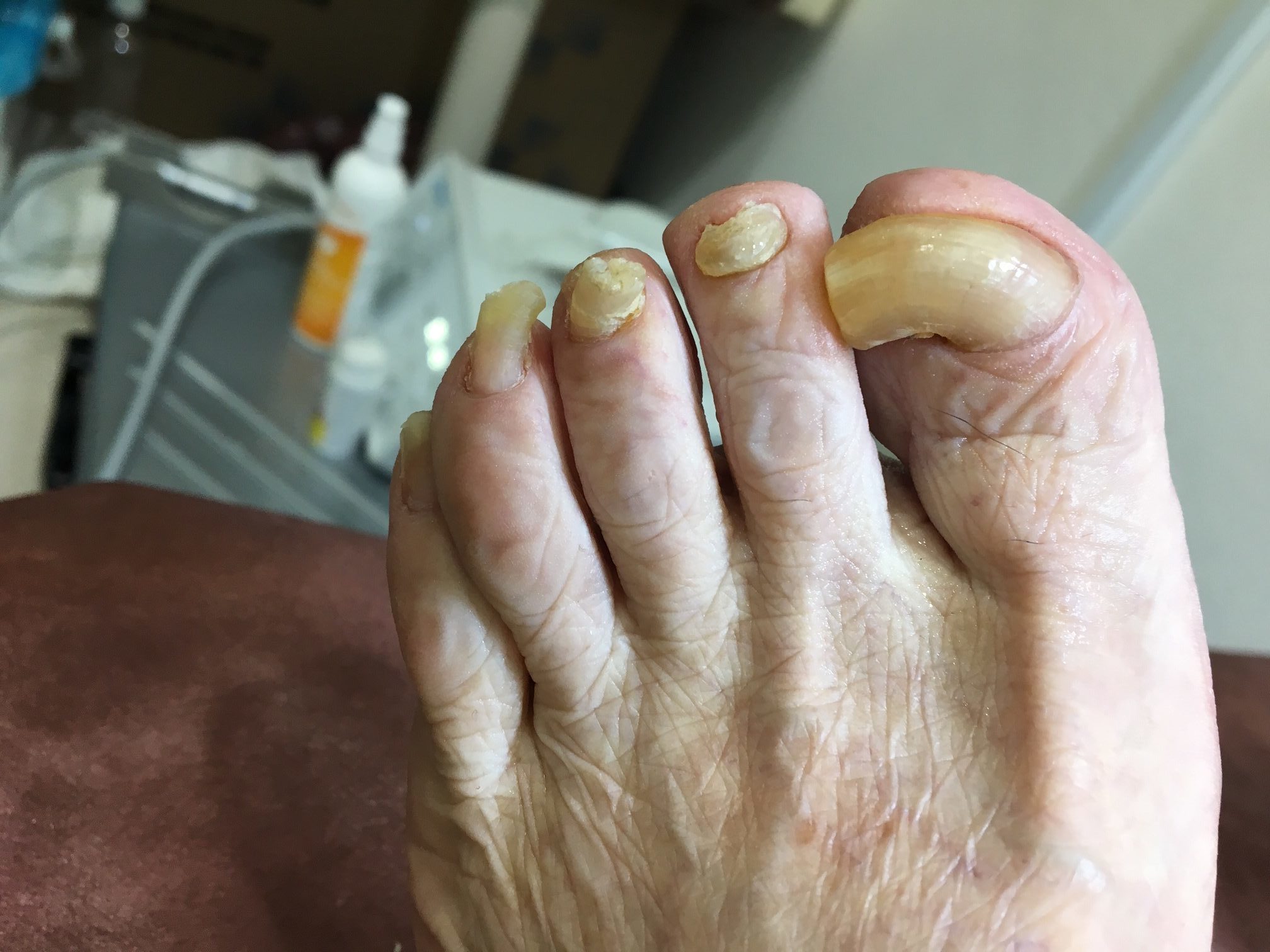 高齢 者 足 の 爪