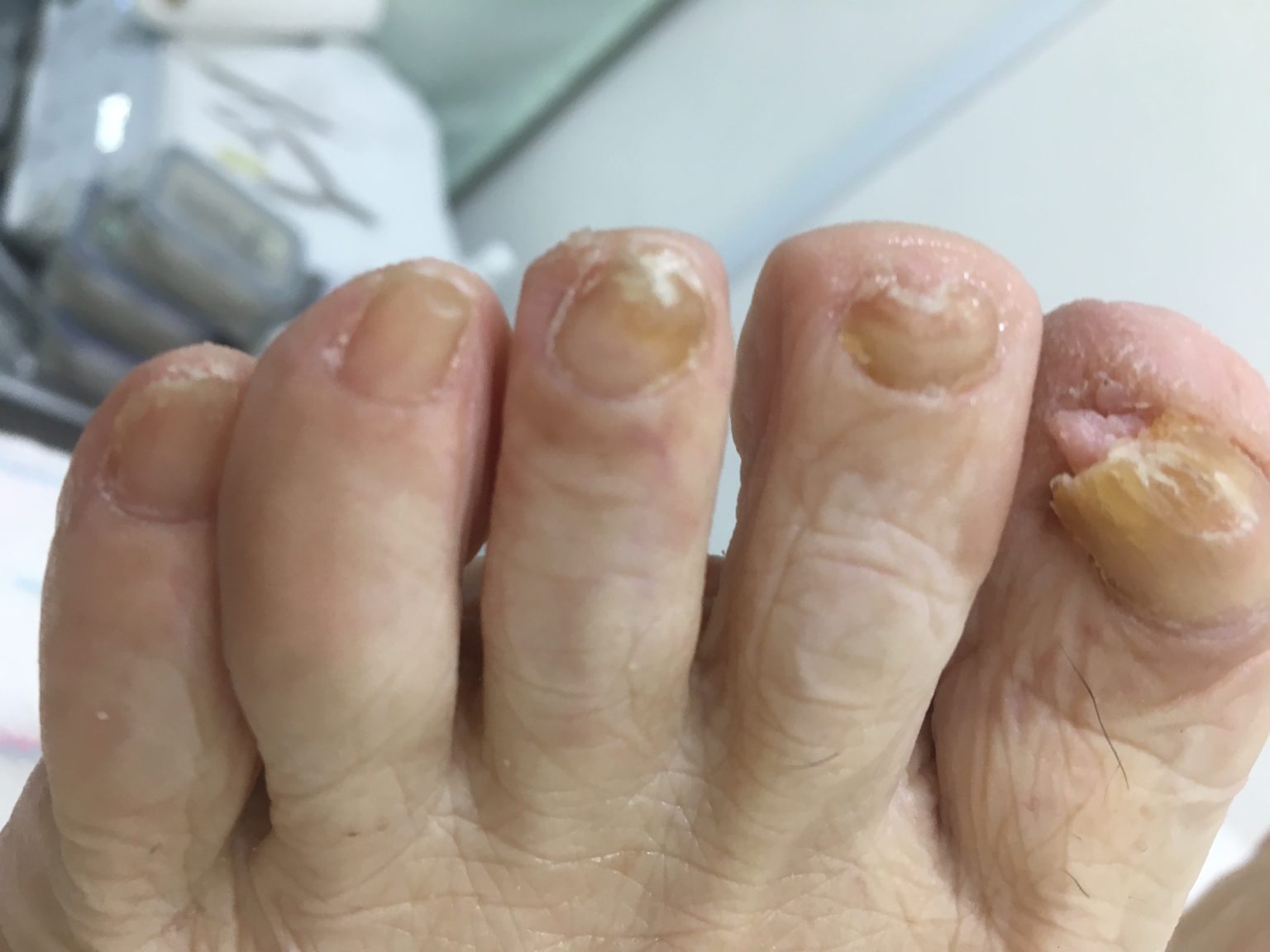 高齢者の巻き爪・肥厚爪 小田原 巻き爪改善 ロージーライフ フット 公式ウェブサイト