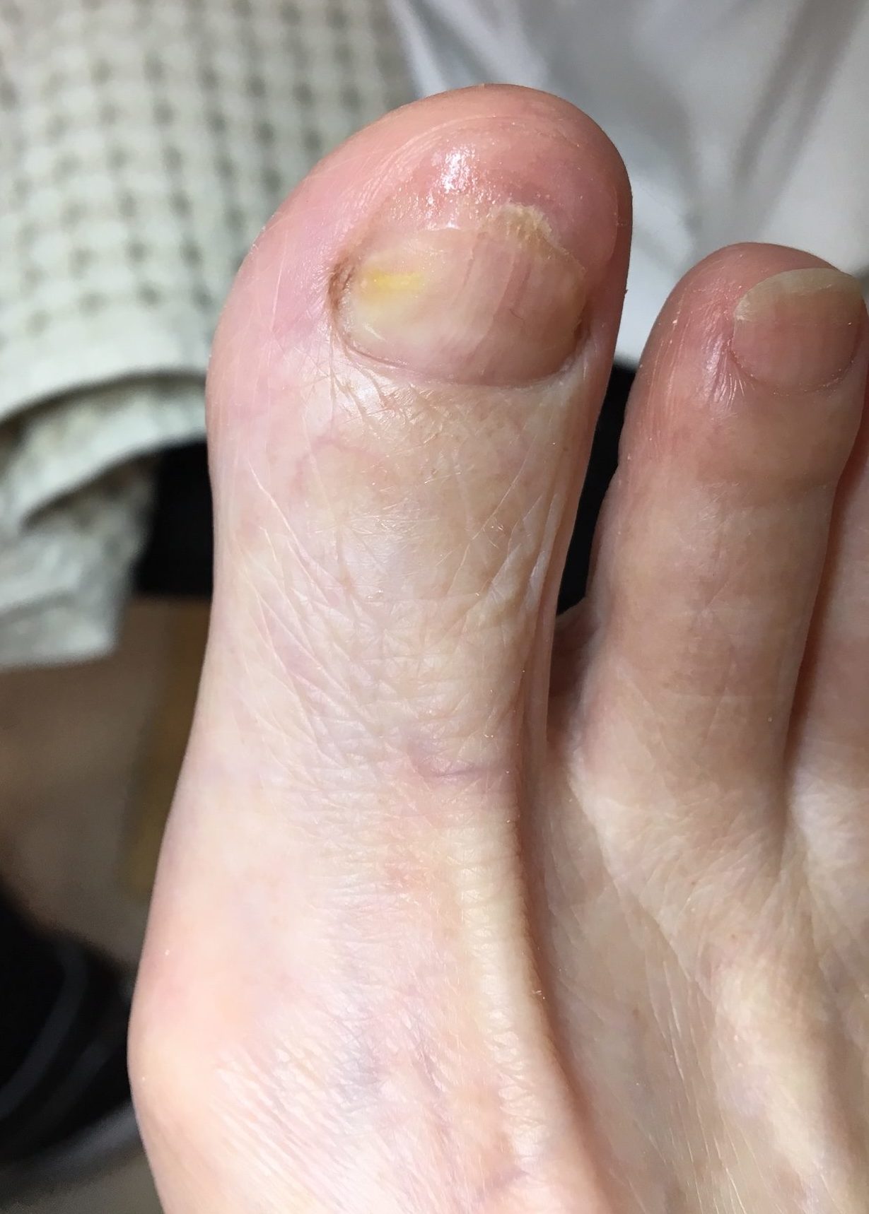 足のトラブル改善 爪の変色 ロージーライフ フット 公式ウェブサイト